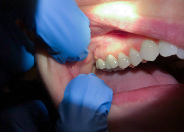 Best Knocked-Out Tooth (Avulsed Tooth) Treatment in Pinetops, NC